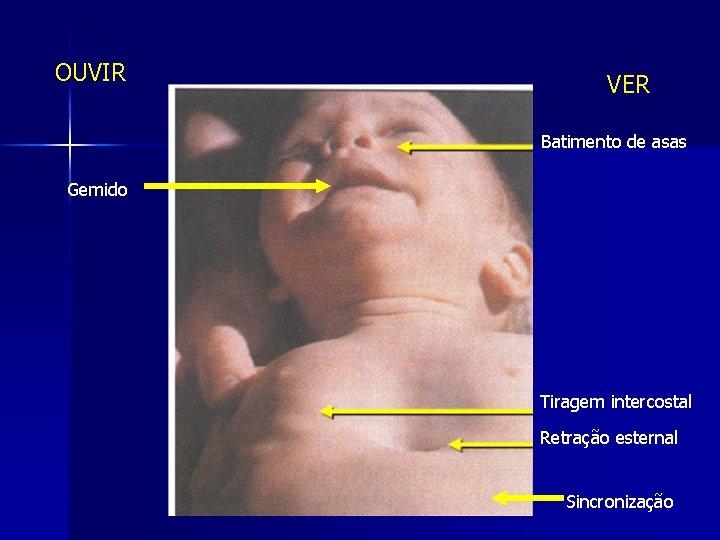 OUVIR VER Batimento de asas Gemido Tiragem intercostal Retração esternal Sincronização 