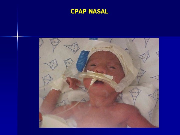 CPAP NASAL 