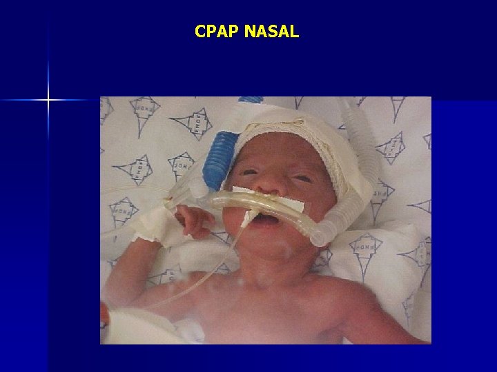 CPAP NASAL 