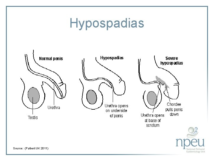 Hypospadias Source: (Patient UK 2011) 