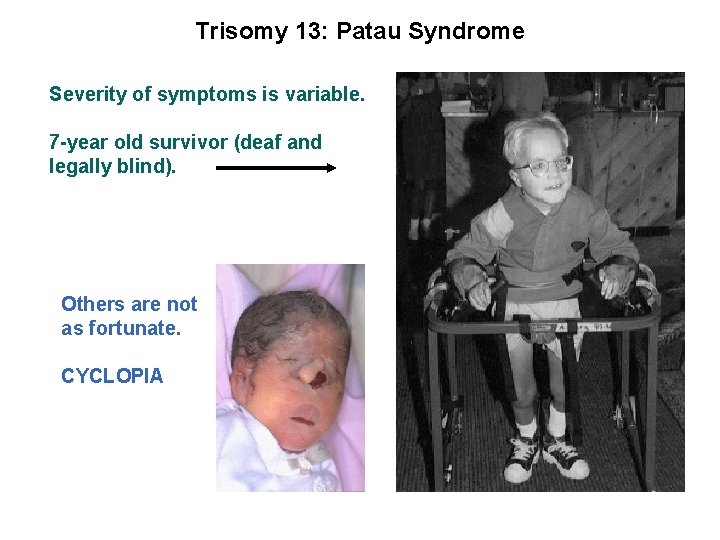 Trisomy 13: Patau Syndrome Severity of symptoms is variable. 7 -year old survivor (deaf