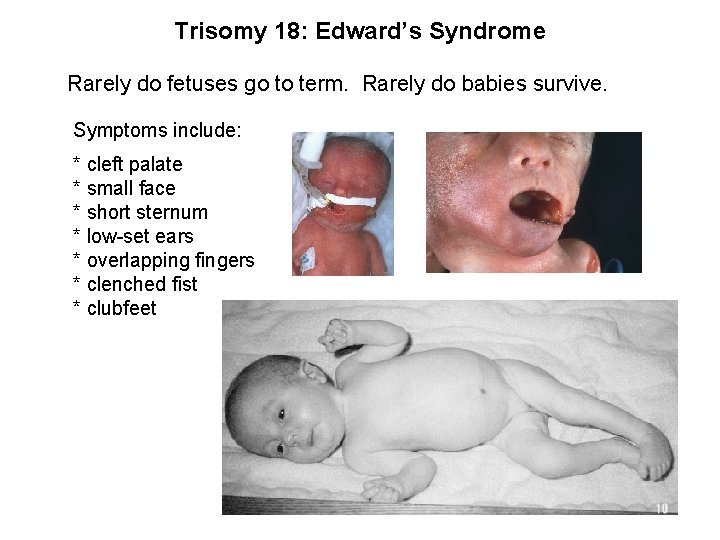 Trisomy 18: Edward’s Syndrome Rarely do fetuses go to term. Rarely do babies survive.