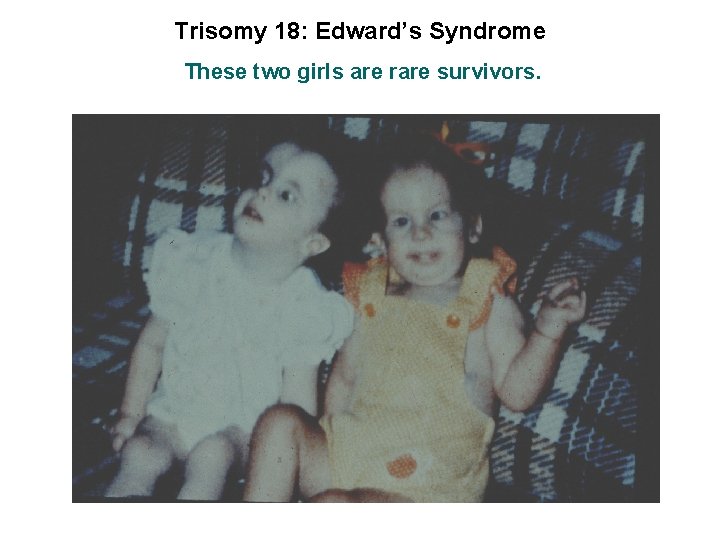Trisomy 18: Edward’s Syndrome These two girls are rare survivors. 