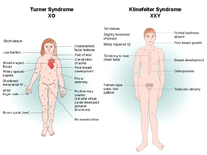 Turner Syndrome XO Klinefelter Syndrome XXY 