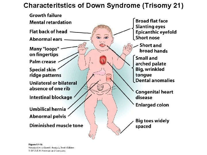 Characteritstics of Down Syndrome (Trisomy 21) 