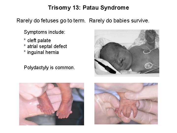 Trisomy 13: Patau Syndrome Rarely do fetuses go to term. Rarely do babies survive.
