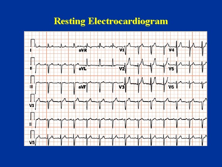 Resting Electrocardiogram 