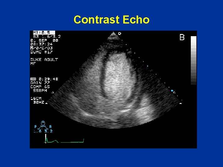 Contrast Echo 