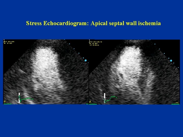 Stress Echocardiogram: Apical septal wall ischemia 