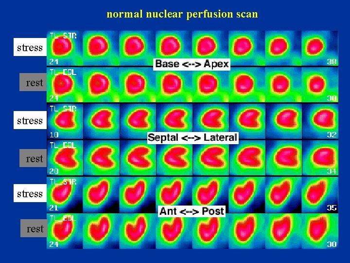 normal nuclear perfusion scan stress rest 