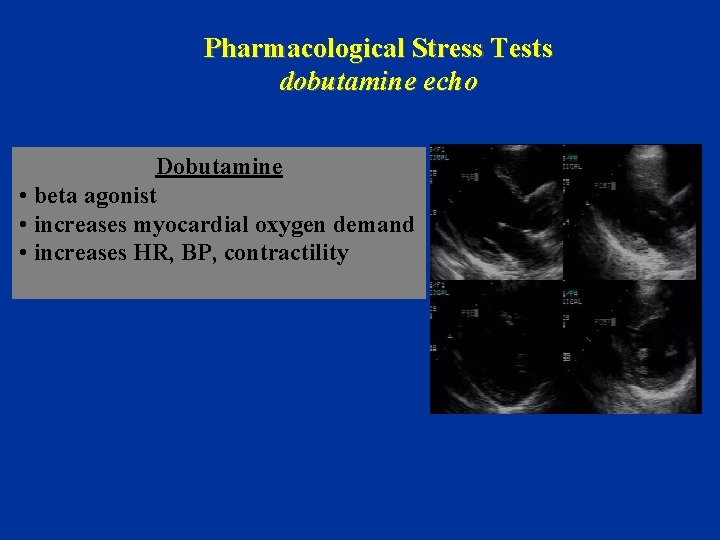 Pharmacological Stress Tests dobutamine echo Dobutamine • beta agonist • increases myocardial oxygen demand