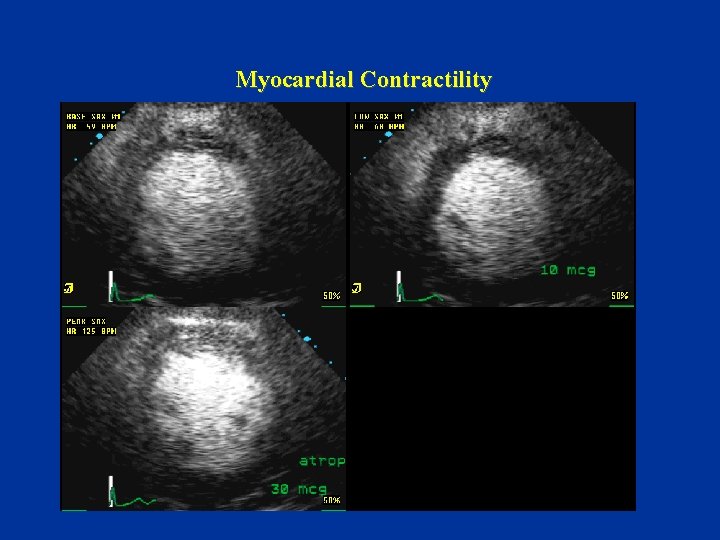 Myocardial Contractility 