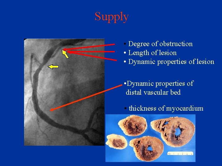 Supply • Degree of obstruction • Length of lesion • Dynamic properties of distal