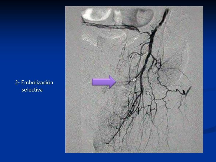 2 - Embolización selectiva 