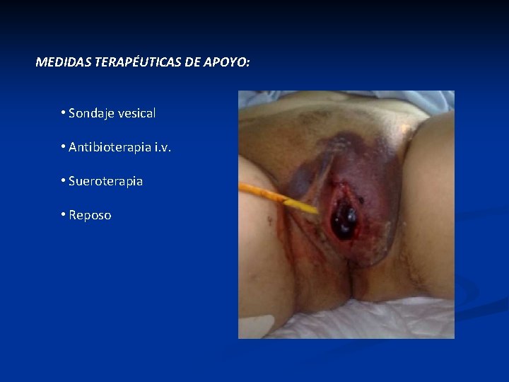 MEDIDAS TERAPÉUTICAS DE APOYO: • Sondaje vesical • Antibioterapia i. v. • Sueroterapia •