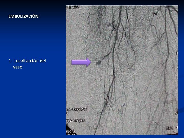 EMBOLIZACIÓN: 1 - Localización del vaso 