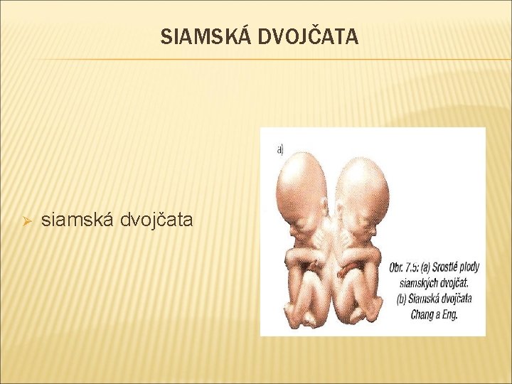 SIAMSKÁ DVOJČATA Ø siamská dvojčata 