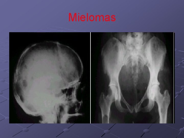 Mielomas Mielomas