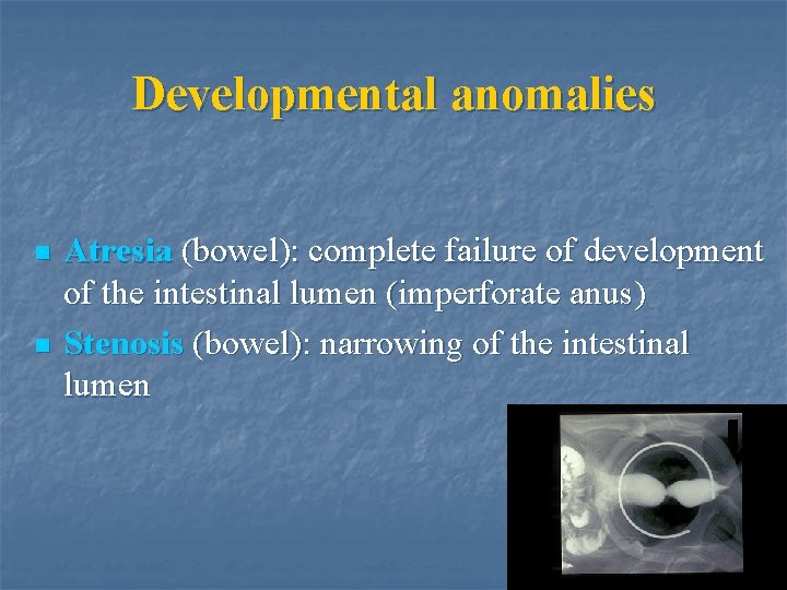 Developmental anomalies n n Atresia (bowel): complete failure of development of the intestinal lumen