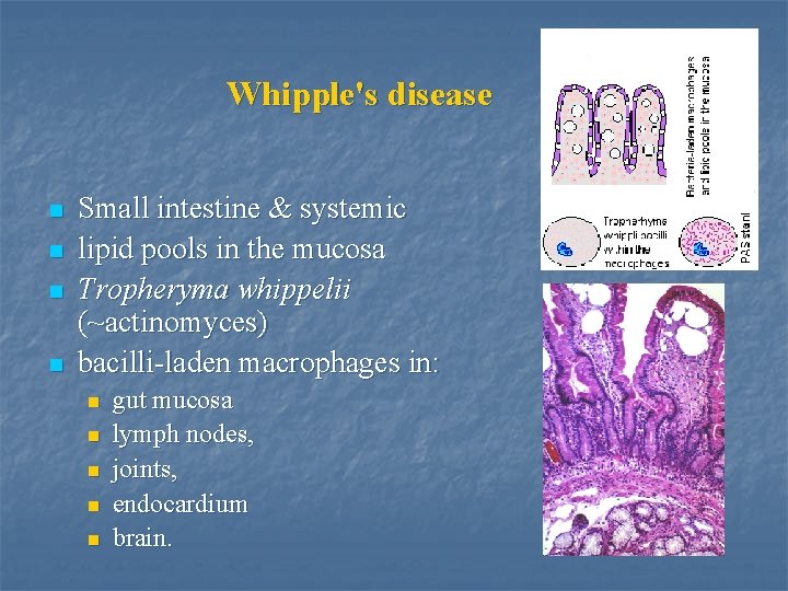 Whipple's disease n n Small intestine & systemic lipid pools in the mucosa Tropheryma