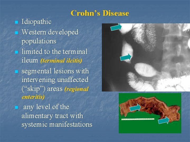 Crohn’s Disease n n Idiopathic Western developed populations limited to the terminal ileum (terminal
