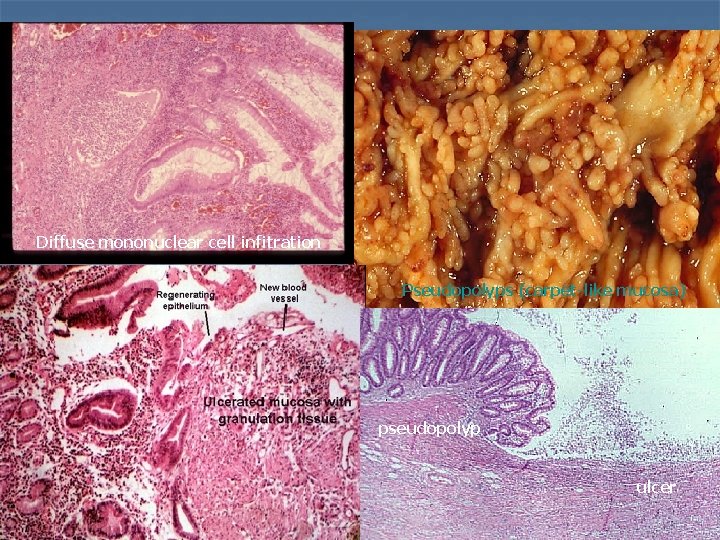 Diffuse mononuclear cell infitration Pseudopolyps (carpet-like mucosa) pseudopolyp ulcer 