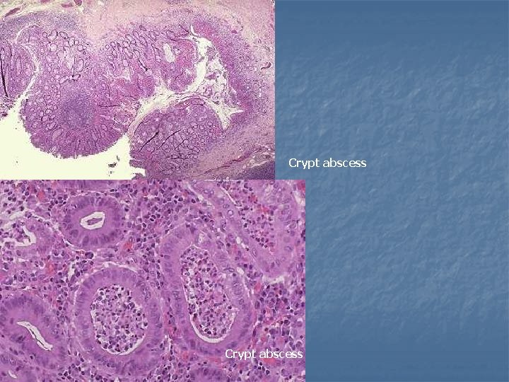 Crypt abscess 