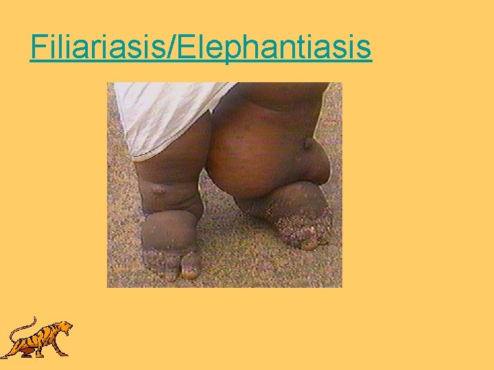 Filiariasis/Elephantiasis 