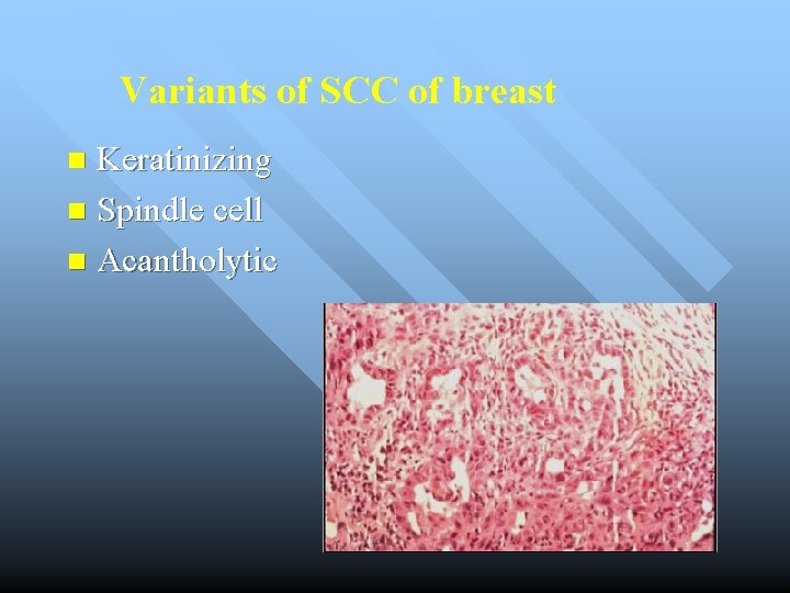 Variants of SCC of breast Keratinizing n Spindle cell n Acantholytic n 