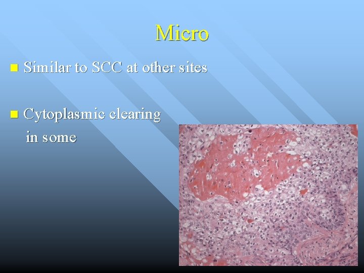 Micro n Similar to SCC at other sites n Cytoplasmic clearing in some 