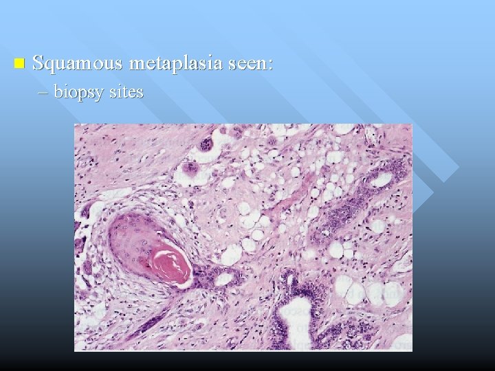 n Squamous metaplasia seen: – biopsy sites 