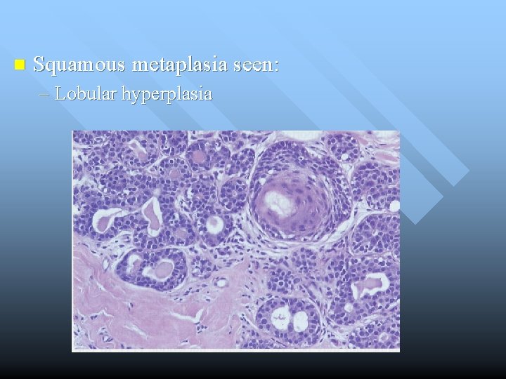 n Squamous metaplasia seen: – Lobular hyperplasia 