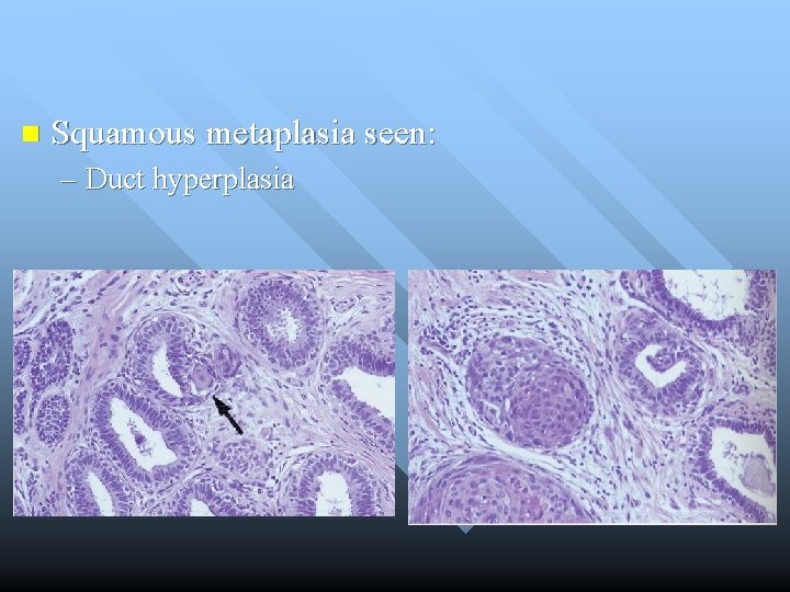 n Squamous metaplasia seen: – Duct hyperplasia 