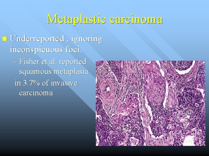 Metaplastic carcinoma n Underreported , ignoring inconspicuous foci. – Fisher et al. reported squamous