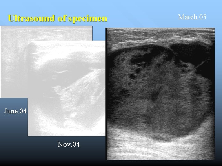 Ultrasound of specimen June. 04 ( cyst 4 cm) Nov. 04 March. 05 