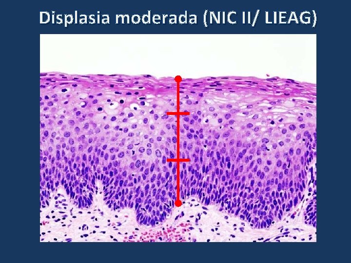 Displasia moderada (NIC II/ LIEAG) Displasia moderada (NIC II/ LIEAG)