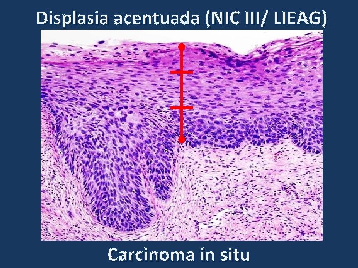 Displasia acentuada (NIC III/ LIEAG) Carcinoma in situ Displasia acentuada (NIC III/ LIEAG) Carcinoma in situ