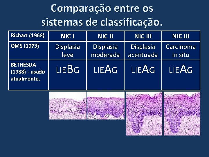 Comparação entre os sistemas de classificação. OMS (1973) NIC I Displasia leve NIC II