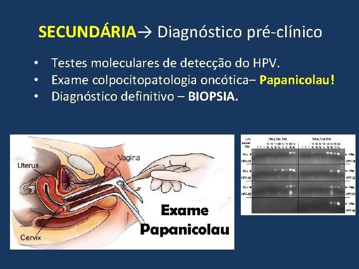 SECUNDÁRIA→ Diagnóstico pré-clínico • Testes moleculares de detecção do HPV. • Exame colpocitopatologia oncótica–