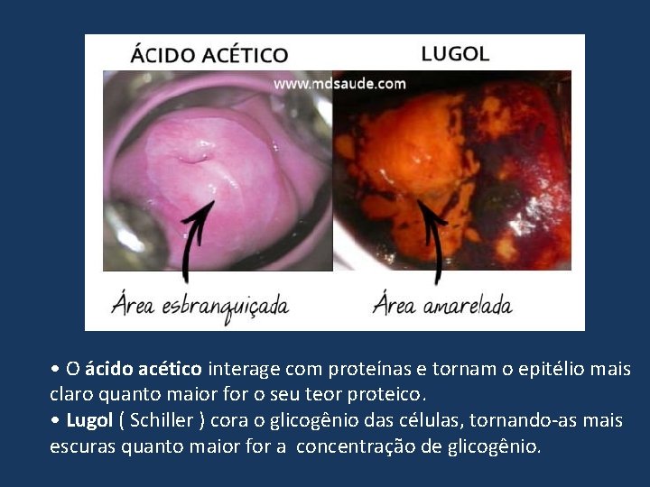  • O ácido acético interage com proteínas e tornam o epitélio mais claro