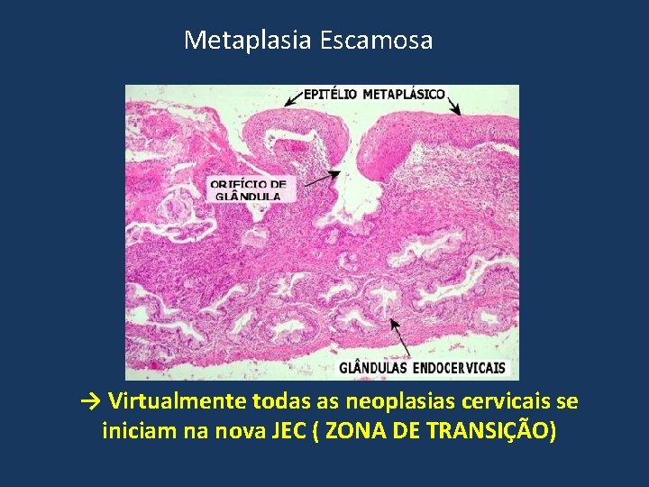 Metaplasia Escamosa → Virtualmente todas as neoplasias cervicais se iniciam na nova JEC (