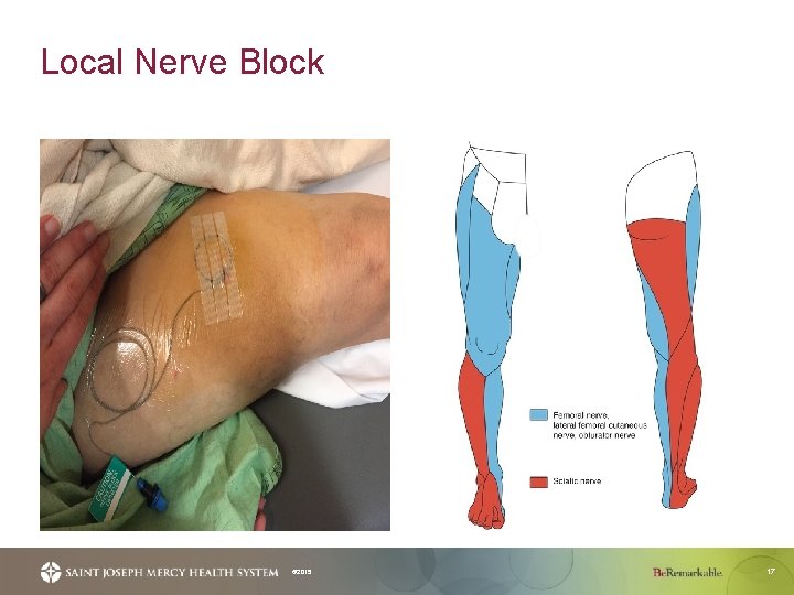 Local Nerve Block © 2015 17 