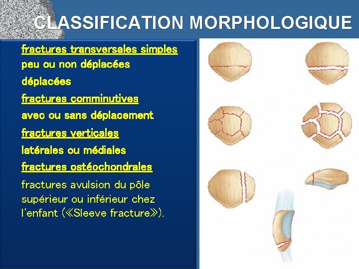 CLASSIFICATION MORPHOLOGIQUE • • fractures transversales simples peu ou non déplacées fractures comminutives avec