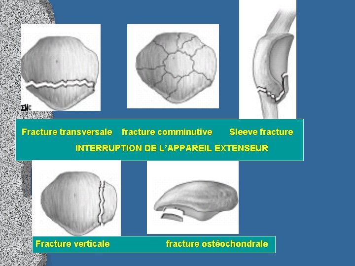 Fracture transversale fracture comminutive Sleeve fracture INTERRUPTION DE L’APPAREIL EXTENSEUR Fracture verticale fracture ostéochondrale