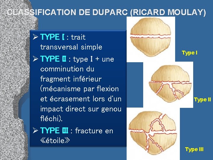 CLASSIFICATION DE DUPARC (RICARD MOULAY) Ø TYPE I : trait transversal simple Ø TYPE