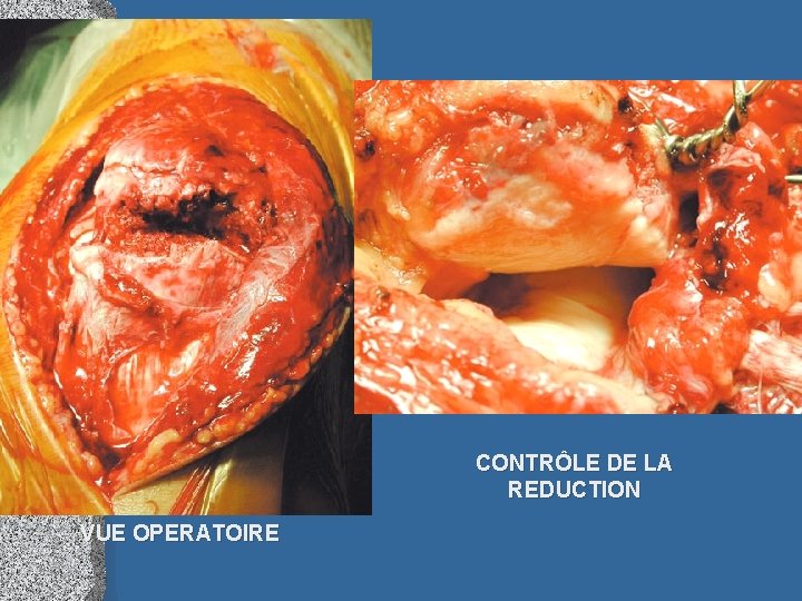 CONTRÔLE DE LA REDUCTION VUE OPERATOIRE 