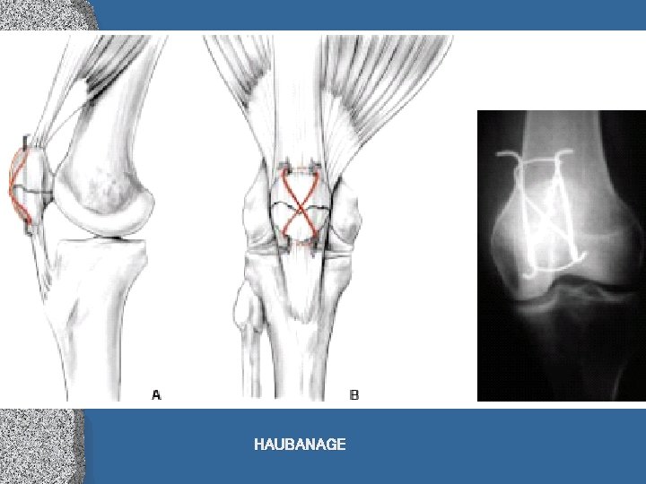 HAUBANAGE 