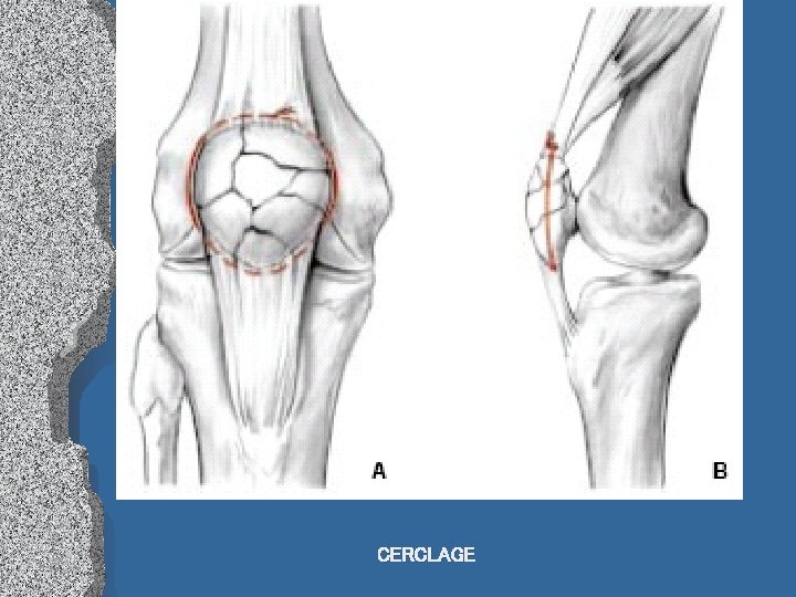 CERCLAGE 