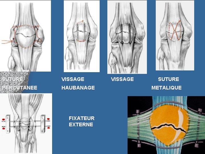 SUTURE VISSAGE SUTURE PERCUTANEE HAUBANAGE METALIQUE FIXATEUR EXTERNE 