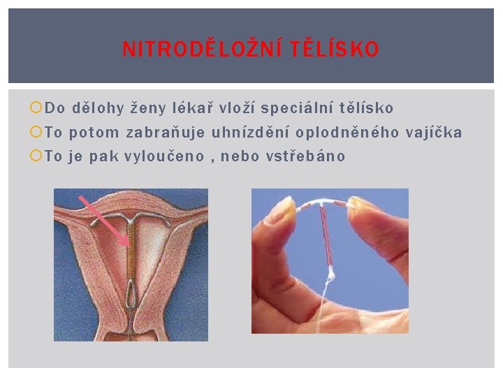 NITRODĚLOŽNÍ TĚLÍSKO Do dělohy ženy lékař vloží speciální tělísko To potom zabraňuje uhnízdění oplodněného